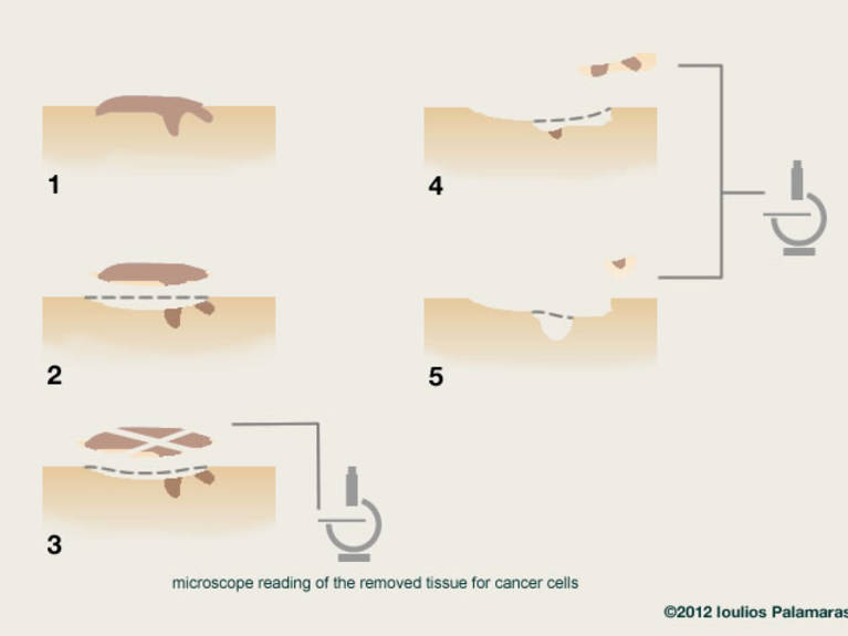 Mohs surgery stages