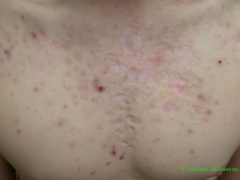 Presence of active acne nodules and widespread post-acne atrophic scarring on chest