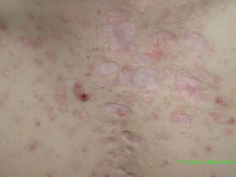 Close up, appreciating in more detail the active acne nodule and the post-acne scars.