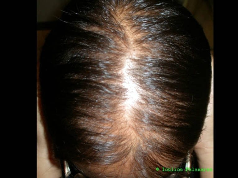 Female pattern androgenetic alopecia