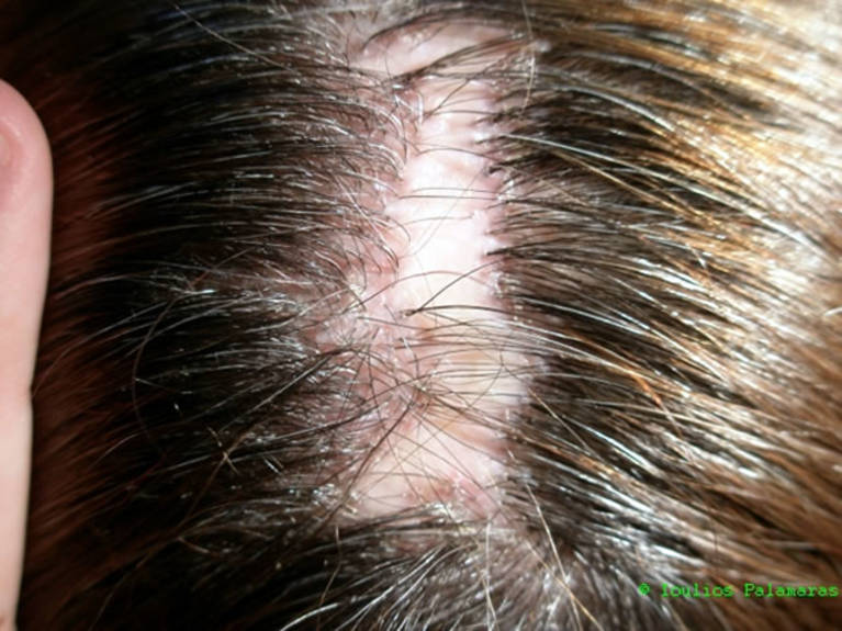 Scarring type of alopecia presenting as a scar in the middle of the scalp with complete loss of hair and their follicular openings