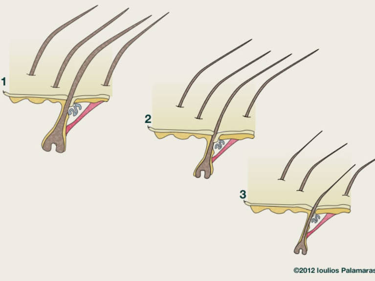 Androgenetic alopecia is caused by slow, gradual and progressive miniaturisation (shrinking) of the hair over many years