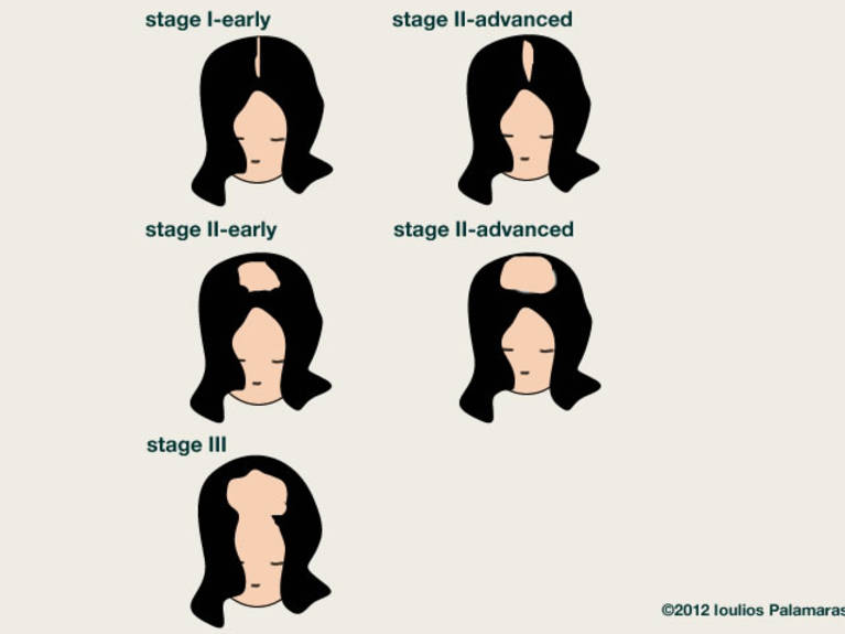 The Ludwig classification for female type of androgenetic alopecia