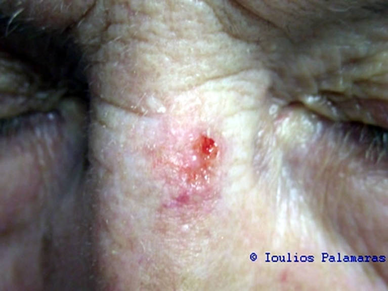 Ulcerative-type of basal cell cancer ("rodent ulcer") on the nose