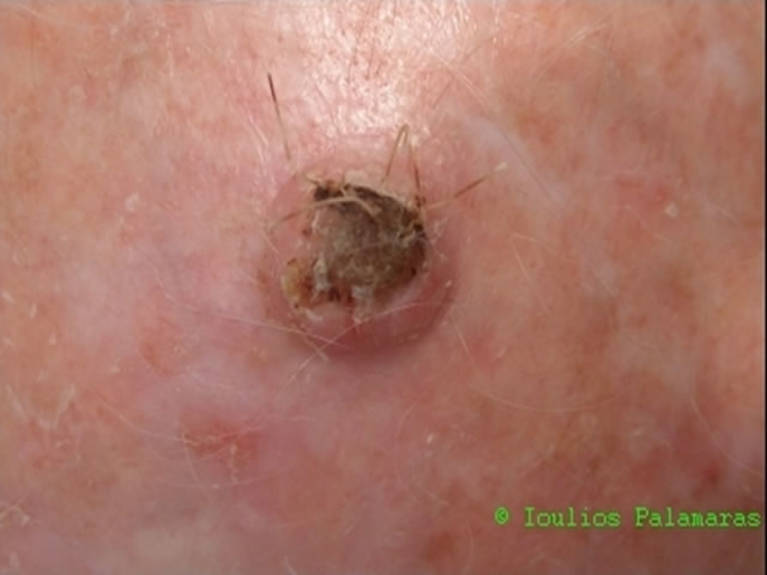 Squamous cell cancer on the scalp (keratoacanthoma-type)