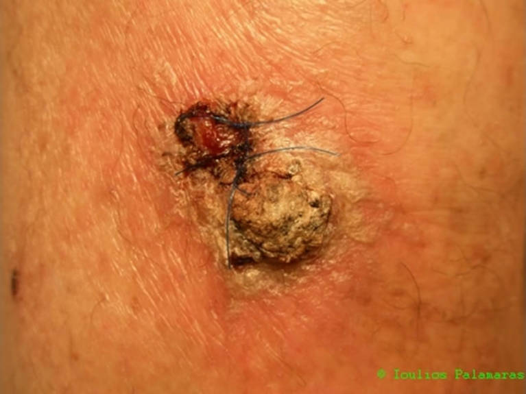 Squamous cell cancer on lower leg