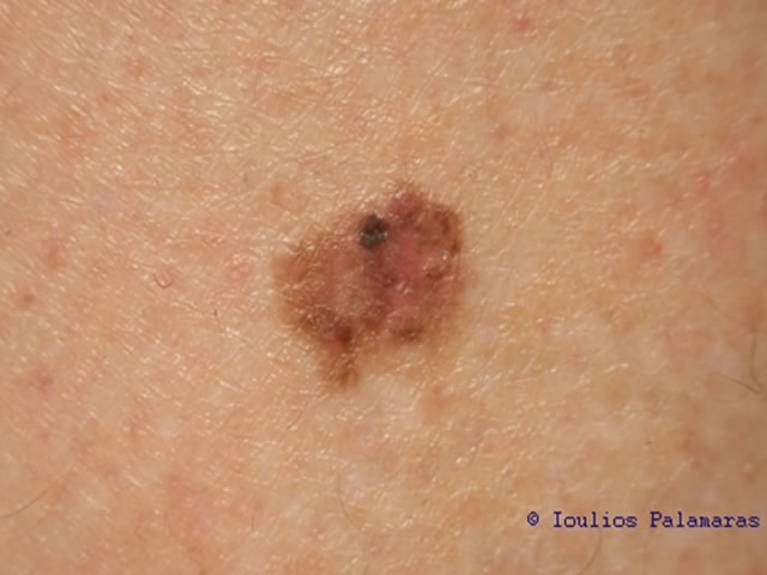 Superficial spreading malignant melanoma on lower leg